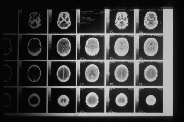 Kasvu Therapeutics raises €30M Series A for depression drug
